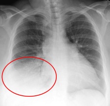 xray-chest-pneumonia